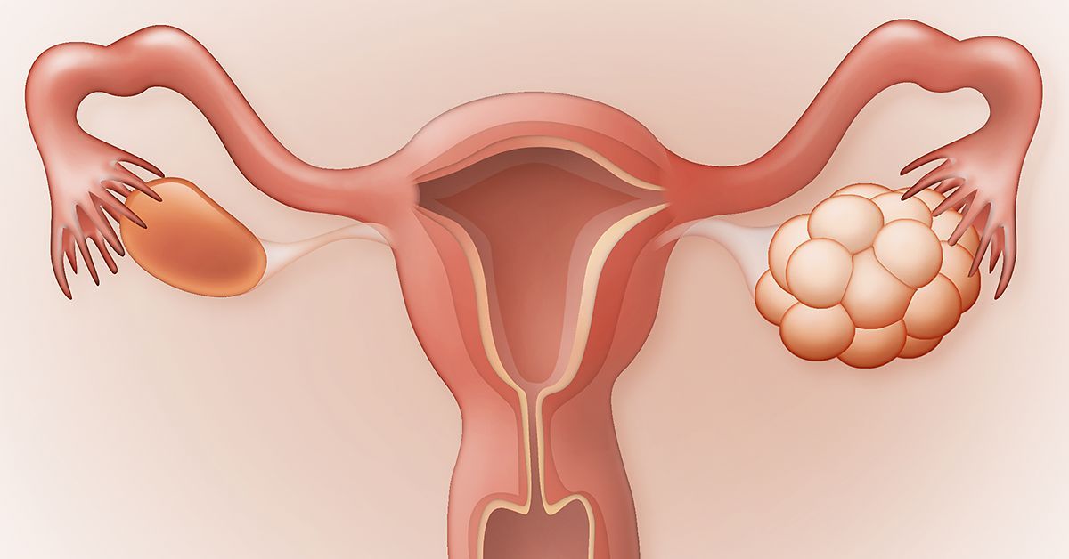 Polycystic Ovarian Syndrome (PCOS) 2 5 Natural Supplements to Treat PCOS Symptoms